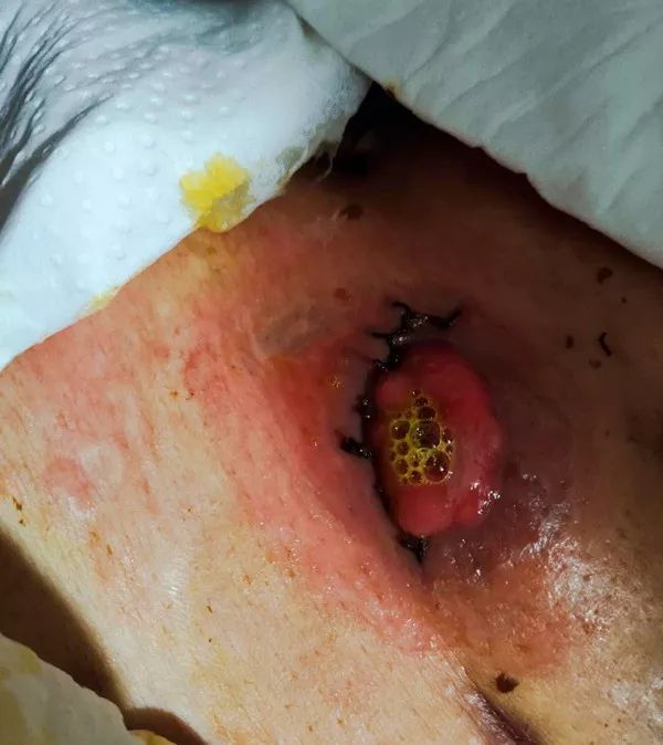 想再耽搁,她想碰碰运气,询问道真县内是否有药房或医院有这种"造口袋"