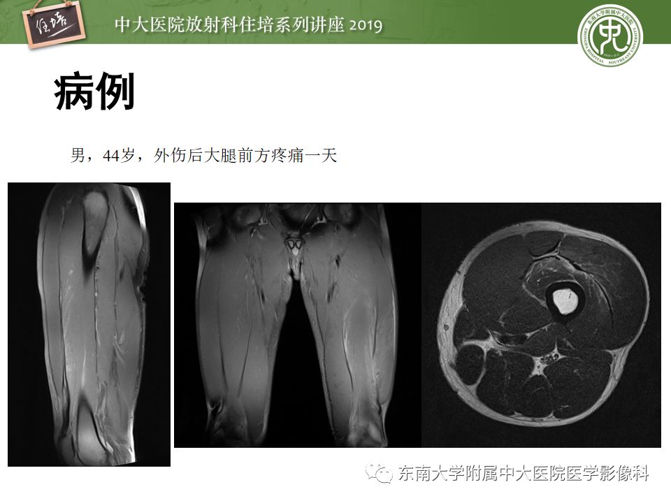 【中大放射住培系列讲座】创伤性肌肉病变的mr诊断