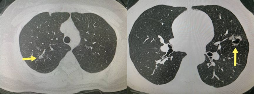 瑞金胸外科普新冠肺炎的磨玻璃影和早期肺腫瘤的磨玻璃影一樣嗎