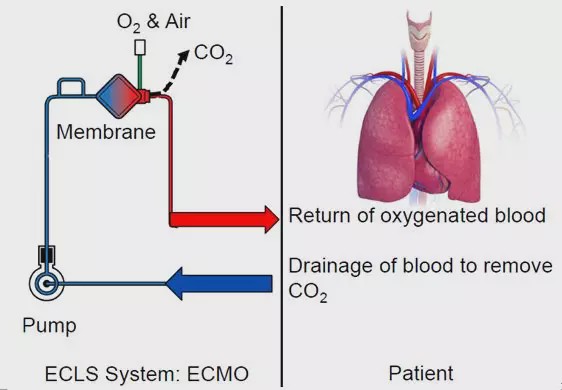 ecmo即移动心肺仪,又称人工肺,是体外肺膜氧合的简称.