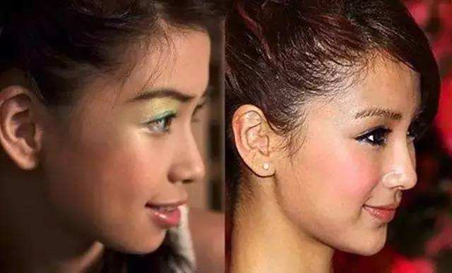 杨颖15岁丑照曝光被质疑整容回应早知道整牙时不拍那么多照片