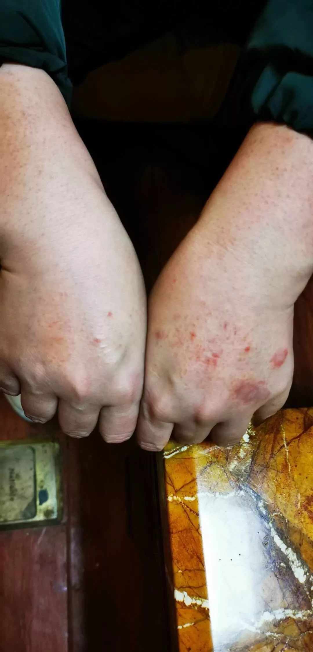 双手因为手套内的滑石粉刺激再加上不透气,皮肤严重过敏2月13日晚10时