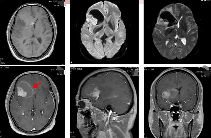 脑胶质瘤磁共振图片