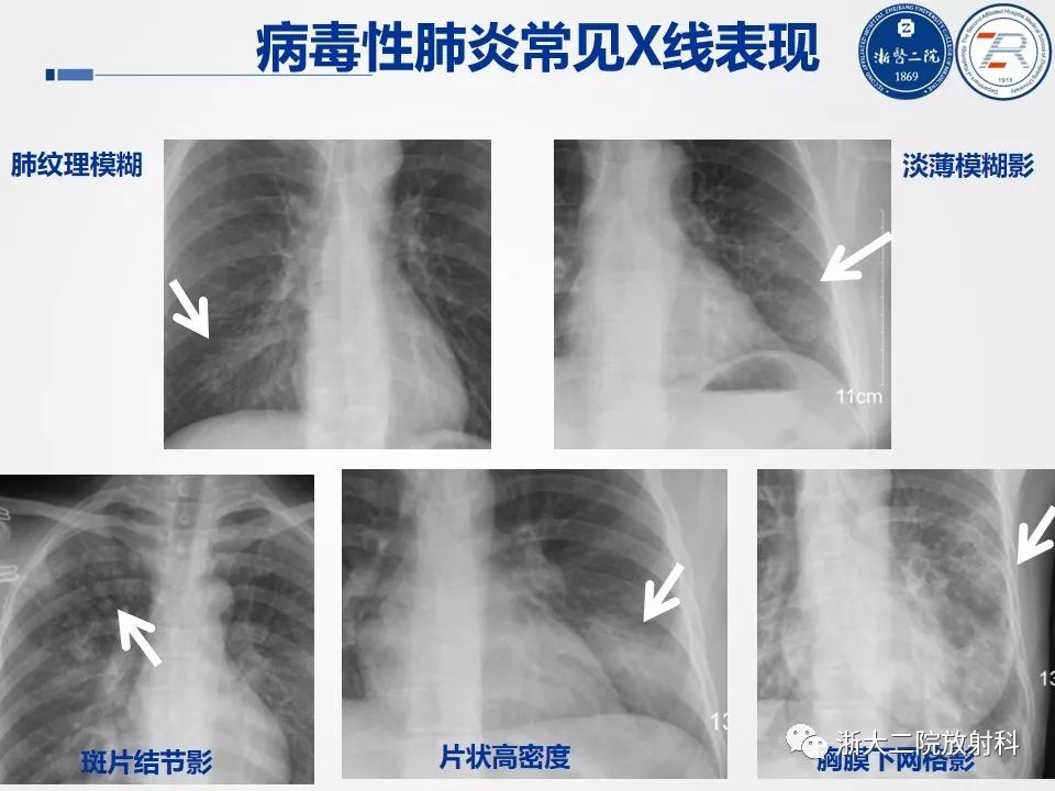 新冠肺炎x线图片