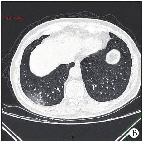 新冠肺部阴影图片