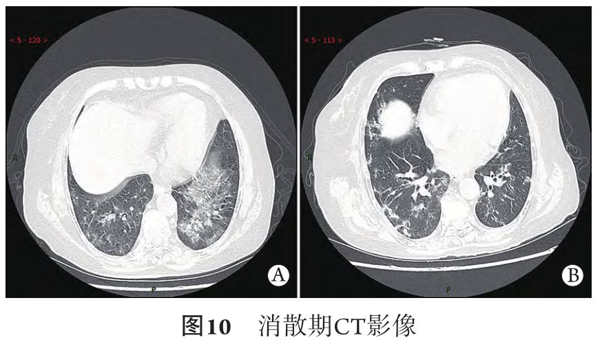 9 天后复查ct右肺中叶病变吸收,右肺下叶病变范围缩小,左肺上叶舌段
