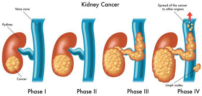 腎癌是起源於腎實質泌尿小管上皮系統的惡性腫瘤,全稱為腎細胞癌,又稱