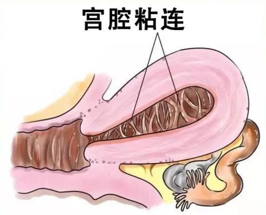 名医谈健康多次流产遭遇宫腔粘连怎么办市中心医院妇产科副主任医师李