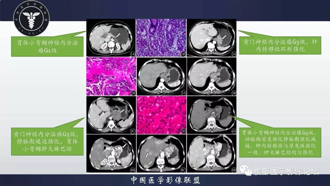 胃神经内分泌肿瘤的影像诊断及鉴别诊断