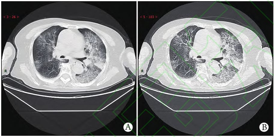 伴咽痛,干咳1周,胸闷和气短加重1周,新型冠状病毒肺炎(1)双肺单发