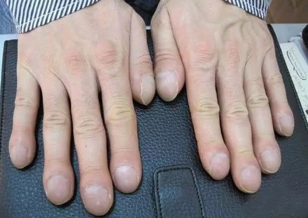 肺癌的发生会伴有明显的哮喘,这是由于肺癌影响气管的症状,哮喘在早期