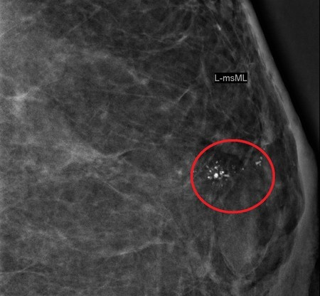 乳房有钙化点别慌!8成以上是良性,3状况需提高警觉_乳腺