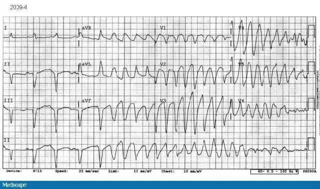 室速常由长间歇后舒张早期室早(ront)诱发.