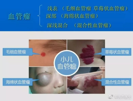 答:  会阴部血管瘤是指肛门周围至生殖器外阴部位的血管瘤,大多适是