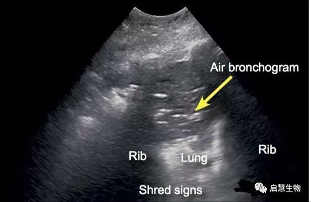 bronchogram图片