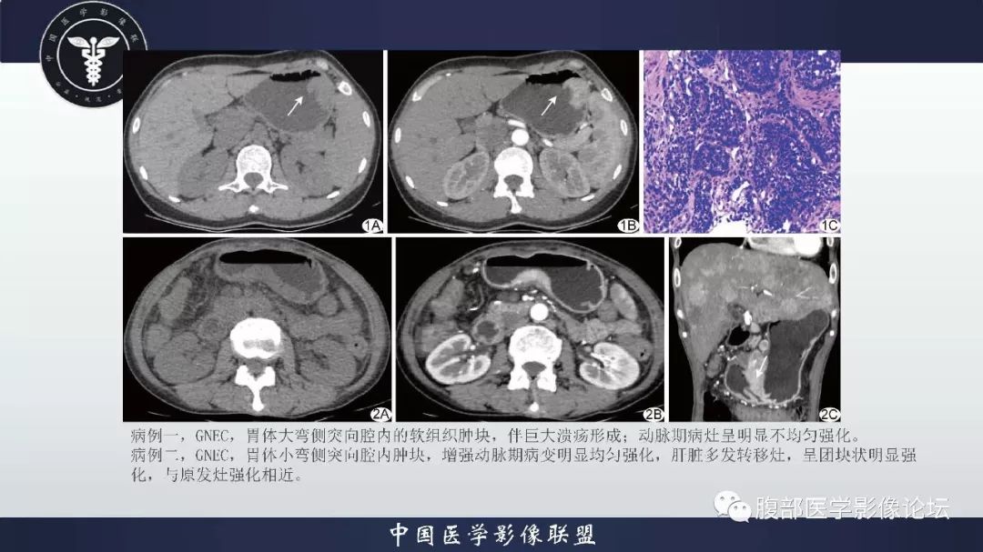 為胃腸道的非上皮性,非肌源性,非神經源性及非淋巴性腫瘤,由梭形及上