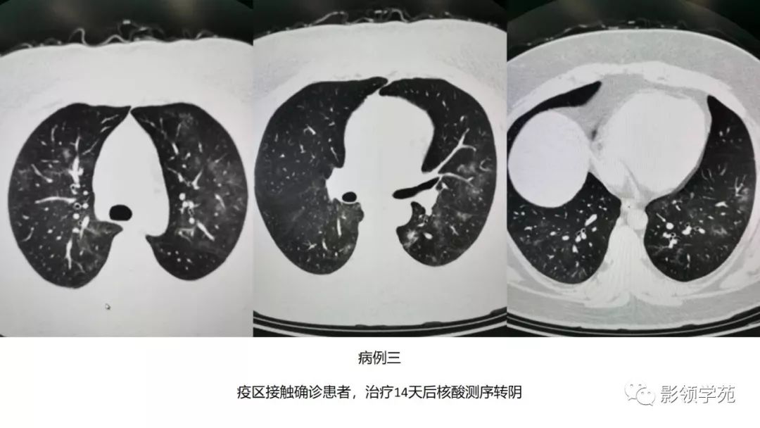 可伴暈徵(滲出性改變);孤立磨玻璃結節,可伴暈徵(滲出性改變);胸水