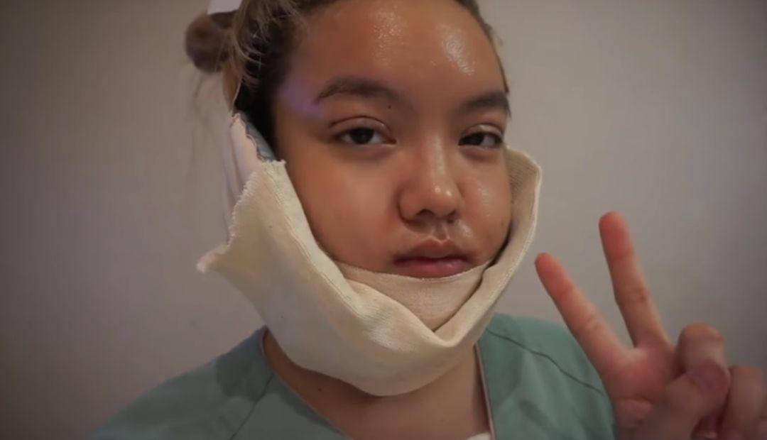 由于下巴动了手术,嘴巴肯定是不能张开的,就更不用说吃东西了,所以