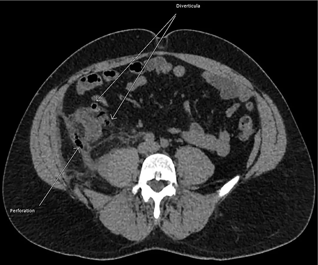 胃肠穿孔的ct图像图片