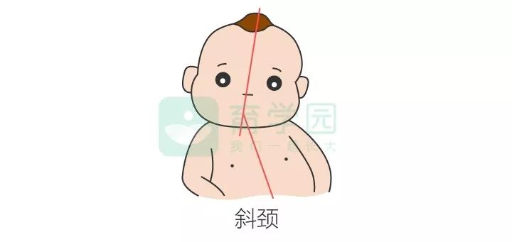 其实,斜颈就是宝宝的头部的中轴线与身体的中轴线不在一条线上