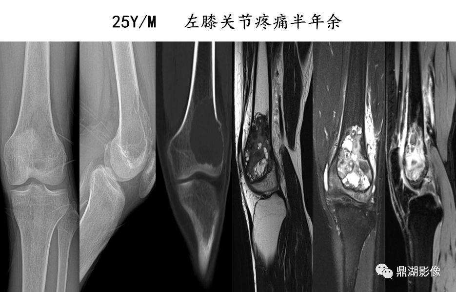 云絮状瘤骨,骨膜反应和codman三角,软组织肿块分类:成骨型,溶骨型