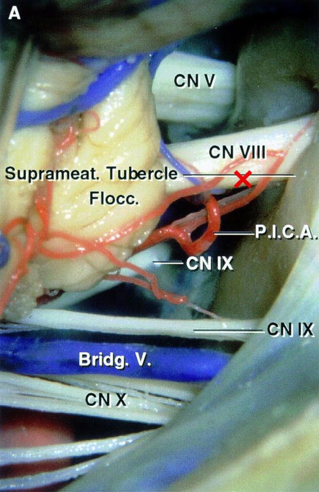 3a红叉标注的三叉神经切迹应为岩上窦沟.