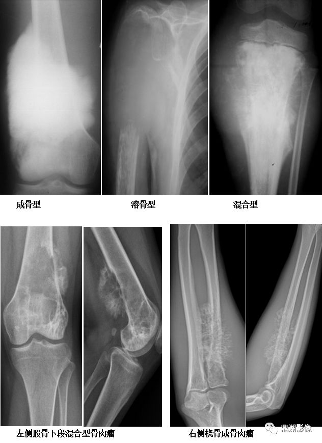 四肢长骨解剖及常见疾病的影像学表现