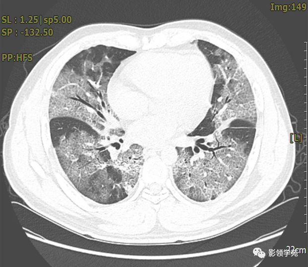 小結雙肺外帶單發或多發斑片狀磨玻璃影(ggo),可伴暈徵(滲出性改變)