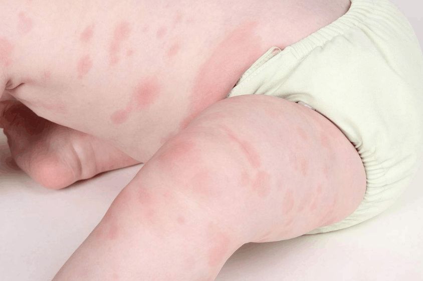 宝宝皮肤容易过敏长红疹,除螨真的不能懈怠啊!