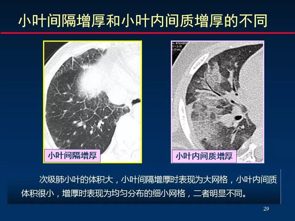 大咖手把手教你判讀肺間質改變的ct表現