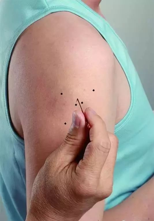 运用:左肩痛扎右穴;右肩痛扎左穴手术:针深五分至一寸取穴:手臂下垂