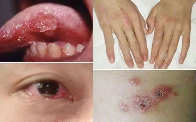如何区分口腔白塞和口腔溃疡?