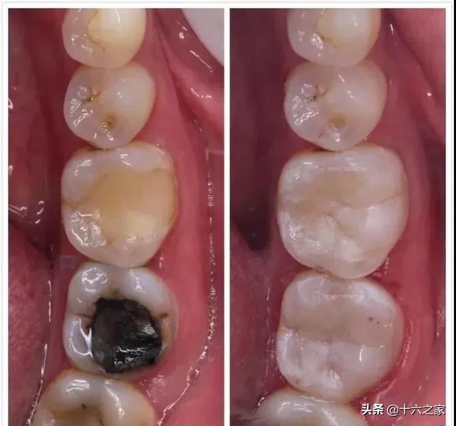 龋坏术前术后影像对比使用热牙胶严密充填根管彻底的对根管进行清理