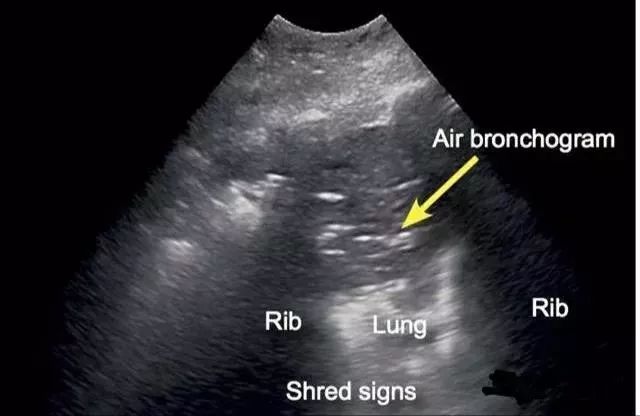 bronchogram图片