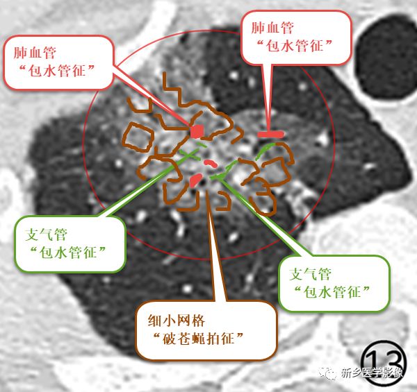 类似于"铺路石征,病变内可见细支气管充气支气管征