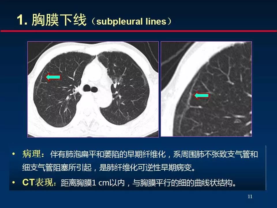 大咖手把手教你判讀肺間質改變的ct表現_解剖