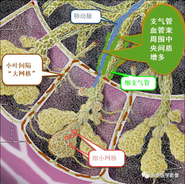 如同包水管表現,未包區域管壁正常,代表了磨玻璃病變內支氣管血管束