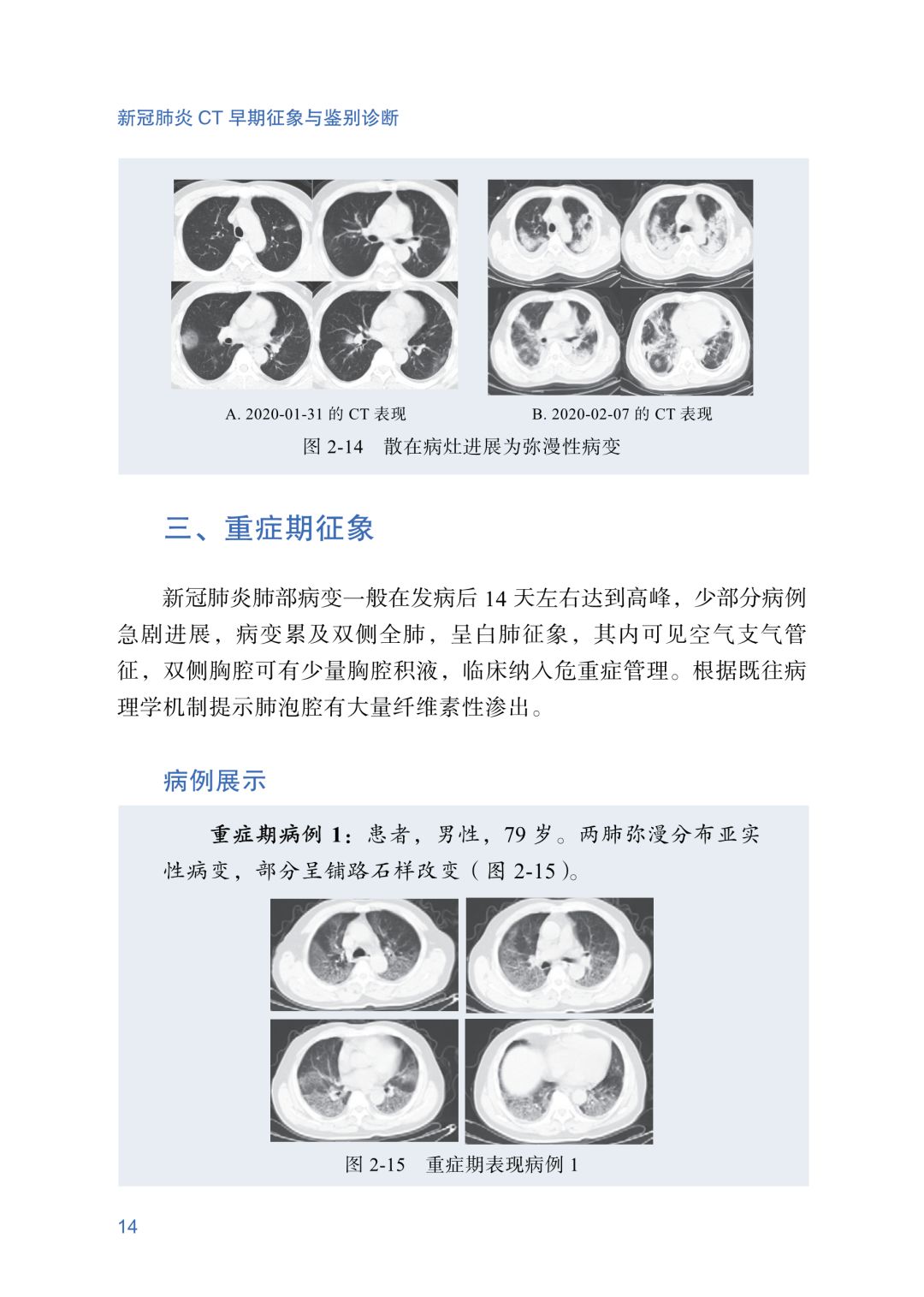 新冠肺炎ct早期征象与鉴别诊断人手一份