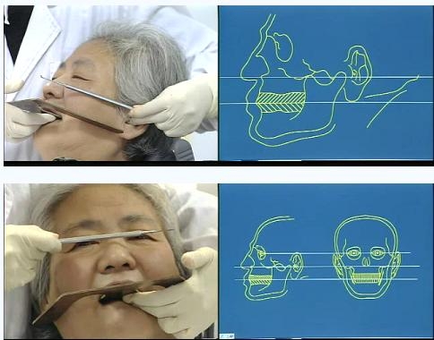 牙医必备全口义齿垂直距离确定图解