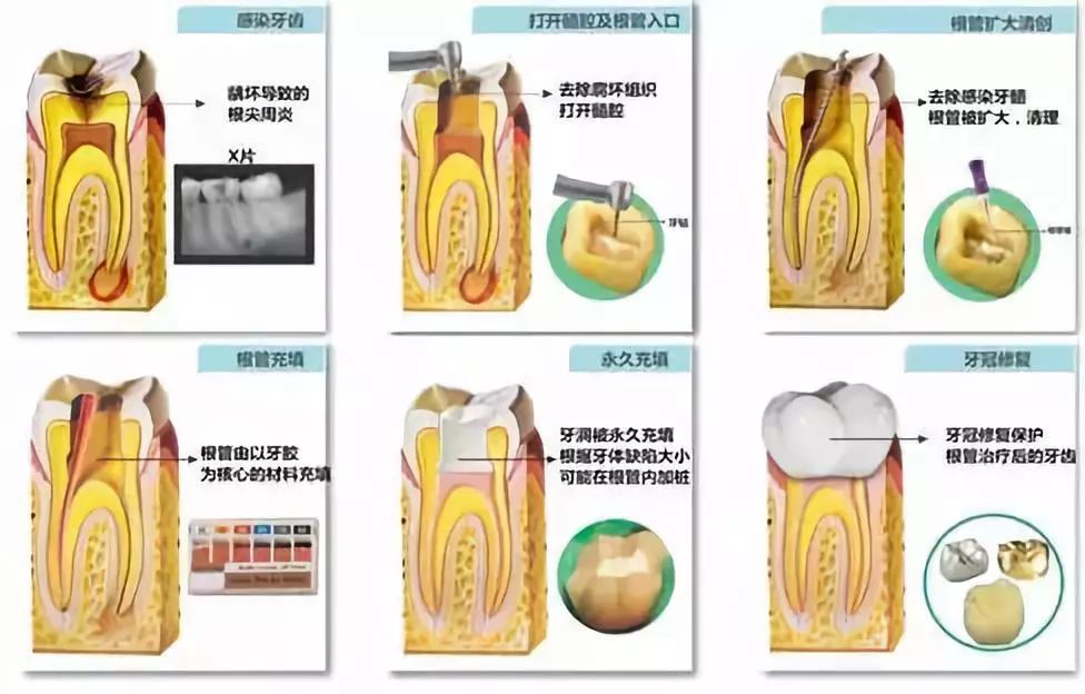 乳牙根管治疗步骤图解图片