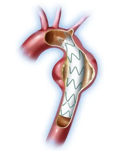 颈动脉瘤支架图片