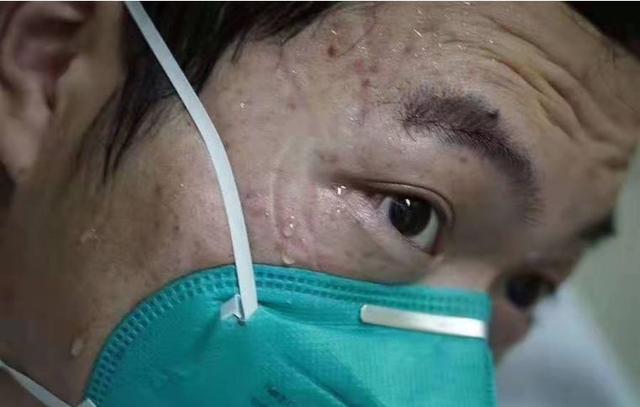 记者用镜头记录下这"最美印痕"脸上被护目镜和口罩压出了深深的印痕