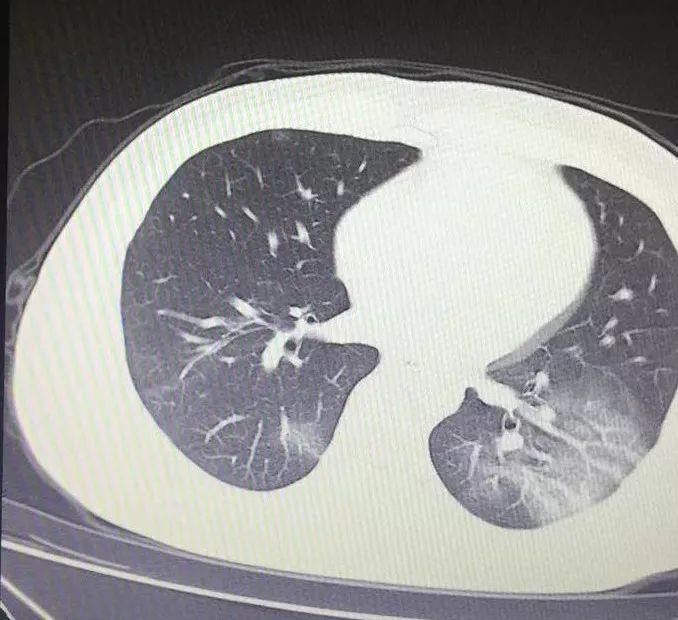 再看另一個:總結其特點,簡單來說就是:這個病ct影像學表現多以肺外帶