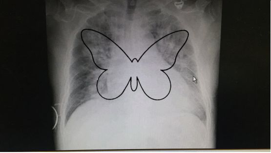 网评最帅心脏外科医生浅谈新冠肺炎与心衰肺炎之影像学鉴别