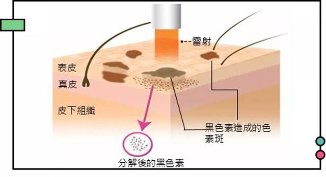 会根据斑点的颜色大小和深度来选择不同波长的激光破坏皮肤内的黑色素