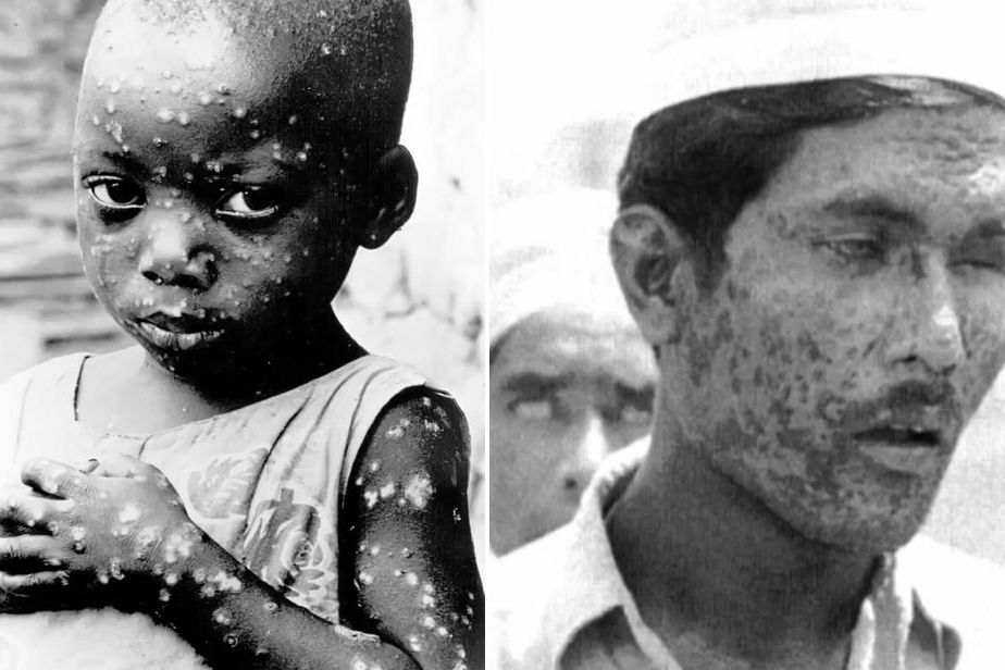 原创 天花病毒是如何被消灭的?