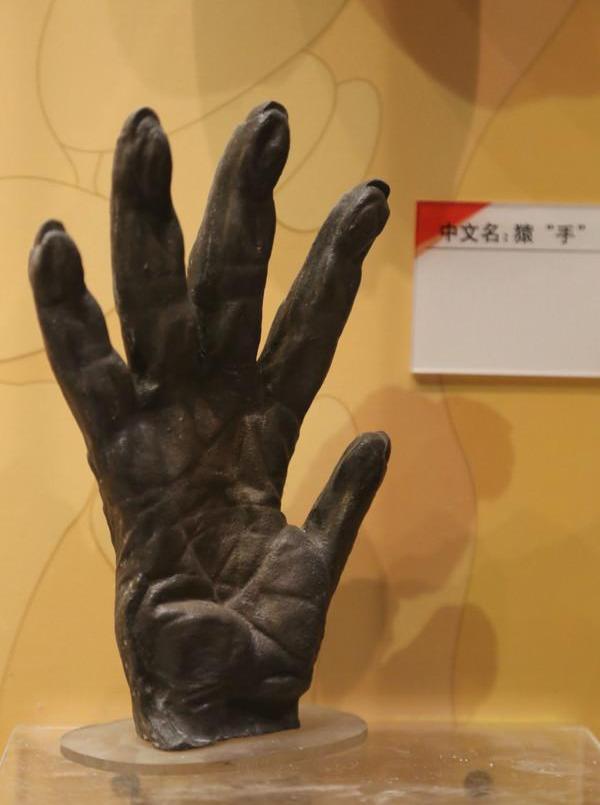 特别强调,不能对掌就是正中神经损伤表现,也就是"猿手".