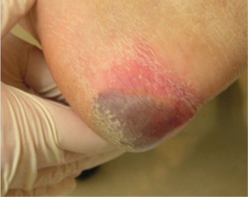 案例一例深部组织损伤分期足跟压疮的根本原因分析