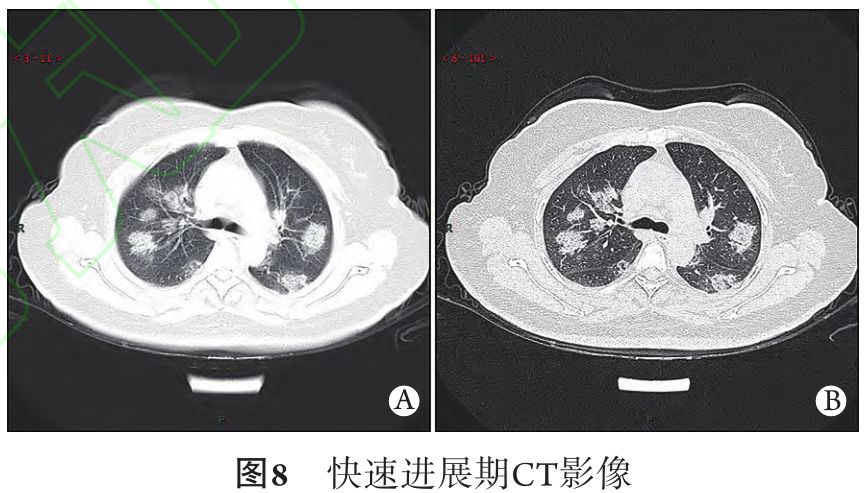 新冠肺炎的ct典型和不典型表现以及影像学分期