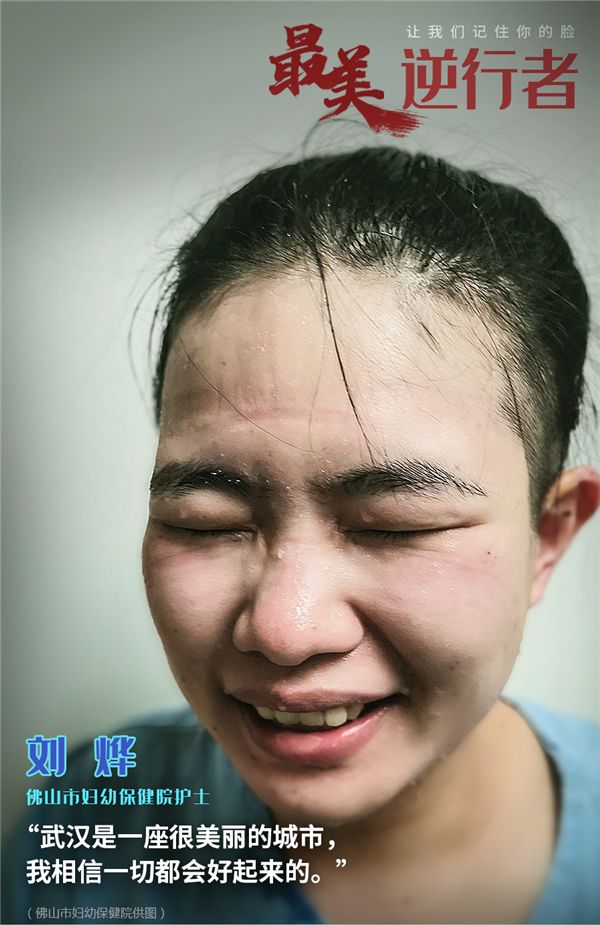 因为长时间佩戴护目镜和口罩,  他们脸上布满勒痕,写满疲惫.